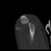 SPORK, NICO - 22.03.1976 - 02.08.2022 - CT obere Extremität - 17:58:51